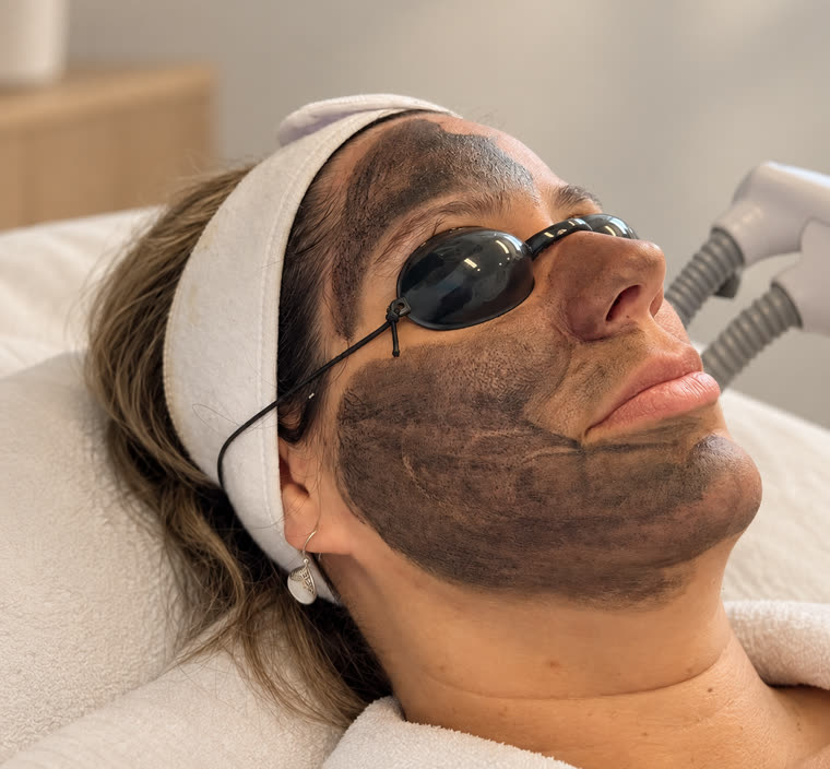 Aktivt kol på huden inför Hollywood Peeling